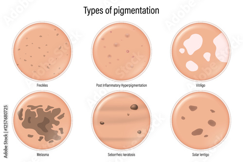 Types of pigmentation. Freckles, Post Inflammatory
Hyperpigmentation, Vitiligo, Melasma, Seborrheic keratosis and Solar lentigo. Skin Pigmentation Disorders.