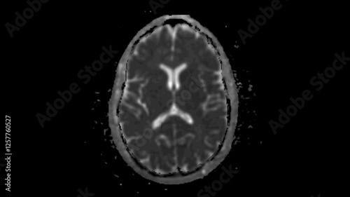 MRI examination of the brain. Apparent diffusion coefficient (ADC) MRI images of the brain. Series description: ADC (10^-6mm/s).