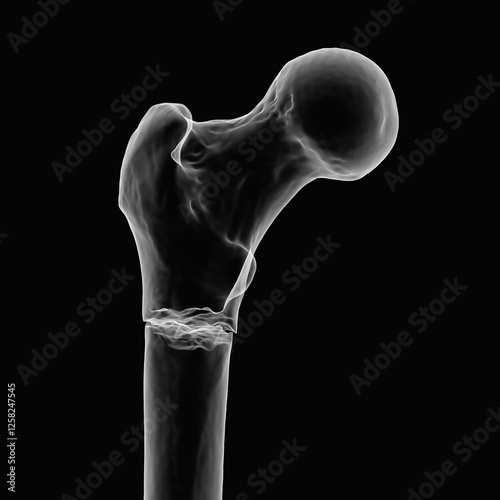 Subtrochanteric femur fracture, 3D illustration photo