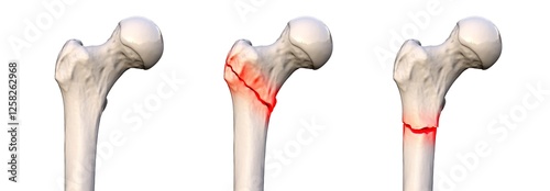 Femur fracture types: normal femur, intertrochanteric fracture, and subtrochanteric fracture, 3D illustration photo