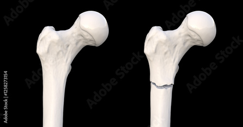 Subtrochanteric femur fracture, 3D illustration photo