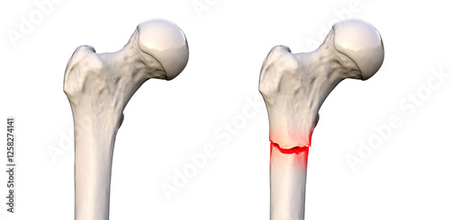 Subtrochanteric femur fracture, 3D illustration photo