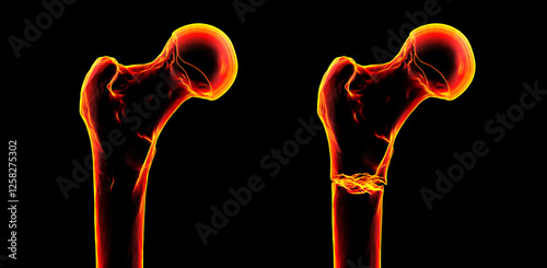 Subtrochanteric femur fracture, 3D illustration photo