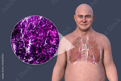 Man with silicosis, 3D illustration and light micrograph photo