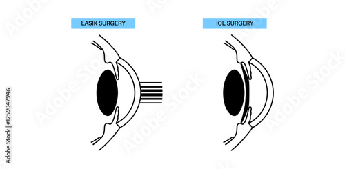 LASIK and ICL EVO