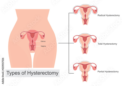 Types of Hysterectomies. Hysterectomy is surgery to remove the uterus.