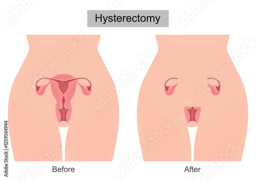 A Hysterectomy is surgery to remove the uterus.