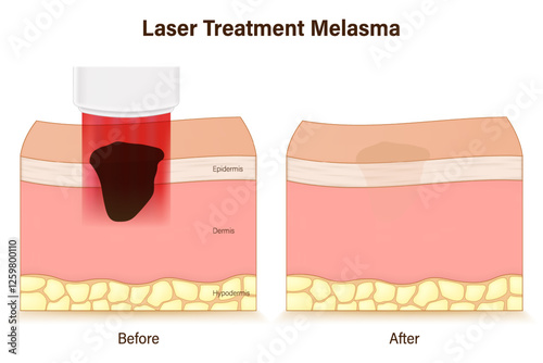 Laser Treatment Melasma. Skin layers during and after melasma treatment with laser. Cosmetic Laser Dermatology. photo