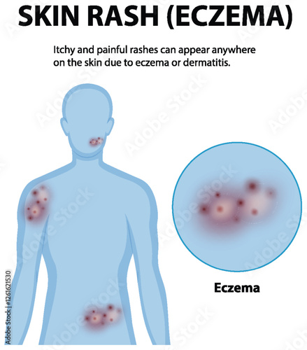 Understanding Eczema and Skin Rashes