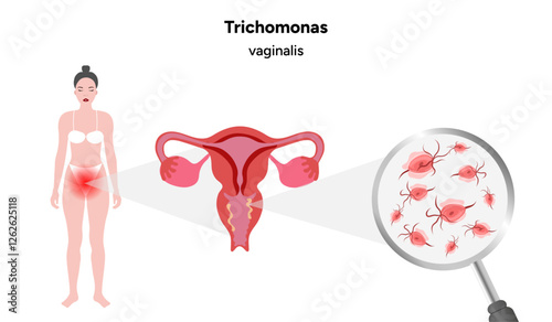 Trichomonas Vaginalis parasites zoom. Men and women infection disease 