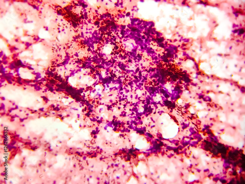 Malignant cells, bronchoalveolar lavage (BAL) adenocarcinoma. Microscopic show cellular material composed of atypical epithelial cells, acute and chronic inflammatory cells.