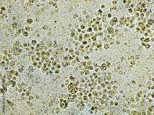 Pyuria or leukocyturia is the condition of urine containing white blood cells or pus. It can be a sign of a bacterial urinary tract infection photo