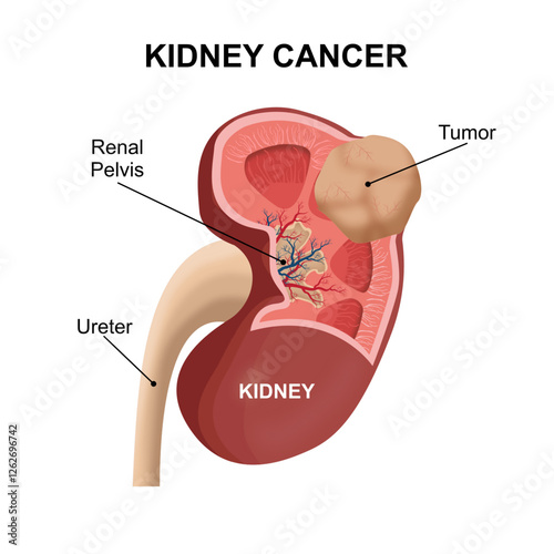 Kidney Cancer Tumor Illustration Cross Section