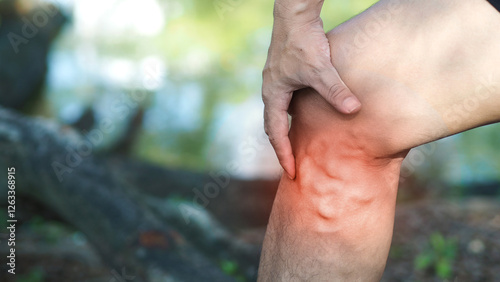 Varicose veins on the legs of men