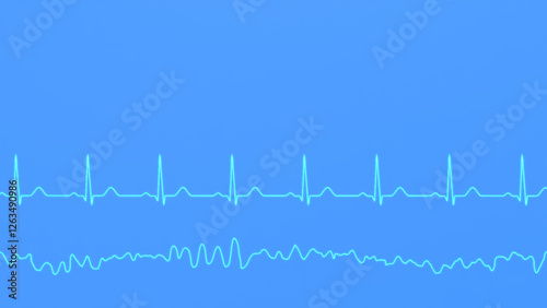 Normal heart rhythm ECG and ventricular fibrillation
