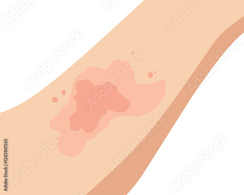 Vector illustration of an allergic reaction on the skin, showing red rashes and irritation