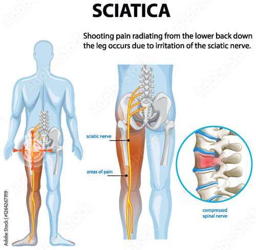 Understanding Sciatica and Its Symptoms