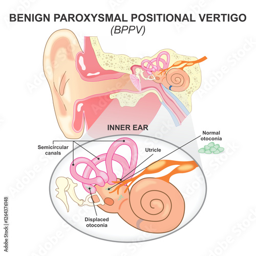 Benign Paroxysmal Positional Vertigo (BPPV)