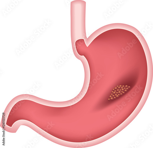 Gastric Cancer. Stomach tumor in the digestive system as a medical and gastrointestinal disease with painful belly symptoms as a medicine concept. Illustration.