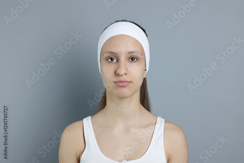 Wallpaper Mural Teenage girl with acne problem on grey background Torontodigital.ca