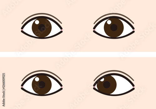 内斜視と正常な目の比較イラスト（Strabismus/Esotropia）