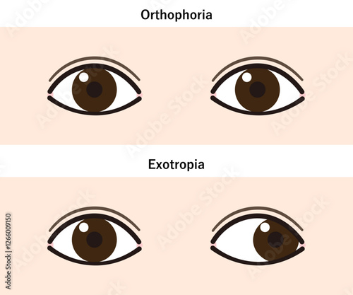 外斜視と正常な目の比較イラスト（Strabismus/Exotropia）