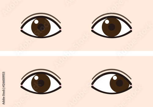 外斜視と正常な目の比較イラスト（Strabismus/Exotropia）