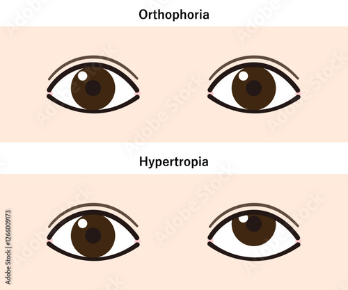 上斜視のイラスト（Strabismus/Hypertropia）
