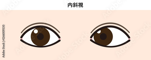 内斜視のイラスト