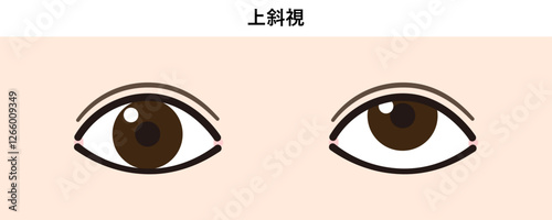 上斜視のイラスト