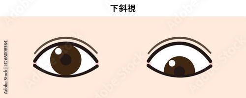下斜視のイラスト