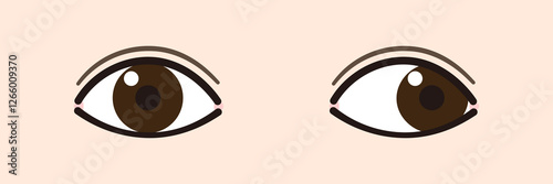 外斜視のイラスト（Strabismus/Exotropia）