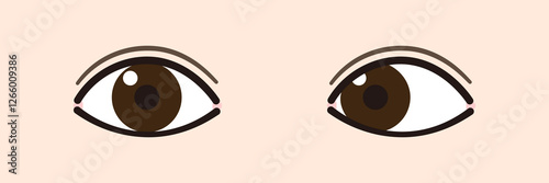 内斜視のイラスト（Strabismus/Esotropia）