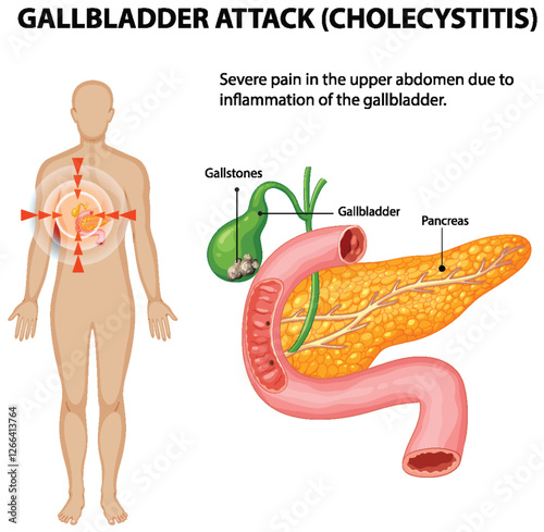 Understanding Gallbladder Attack and Cholecystitis