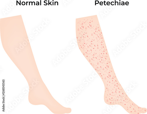 Normal Skin Petechiae Science Design Vector Illustration Diagram