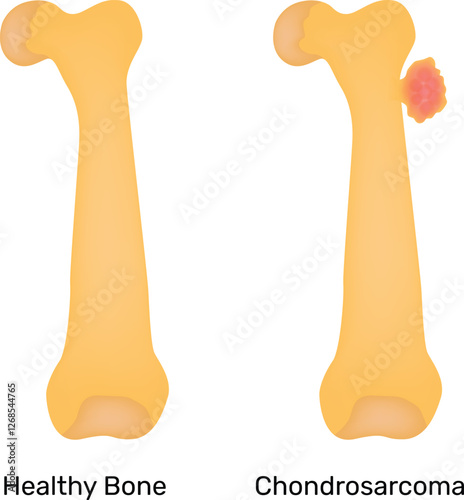 Healthy Bone Chondrosarcoma Science Design Vector Illustration Diagram