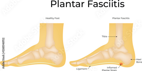 Healthy Foot and Plantar Fasciitis Foot Science Design Illustration Diagram