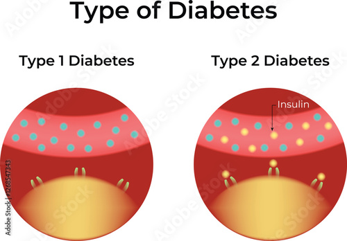Type of Diabetes Science Design Vector Illustration Diagram