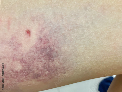detail of a dog bite wound on a leg. Dog Bite Wound on Caucasian Leg Bloody Punctures and Purple Bruising