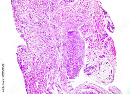 Male, 35 years old, gout, pathological section of left thumb. Gout nodules are composed of acellular, amorphous and weakly eosinophilic substances, showing a granulomatous appearance. Magnify 40x. photo