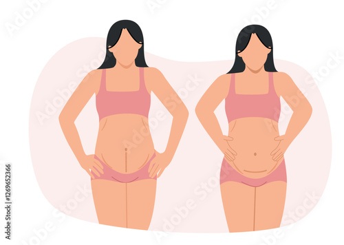 Two women with cesarean section wounds that are horizontal along the waistband of their panties and vertical below their navel.