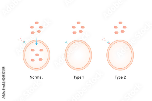 Type 1 and Type 2 Diabetes Science Design. Vector Illustration.