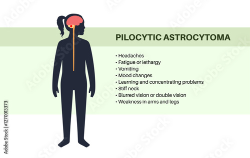 Pilocytic astrocytoma poster