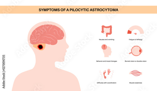 Pilocytic astrocytoma poster