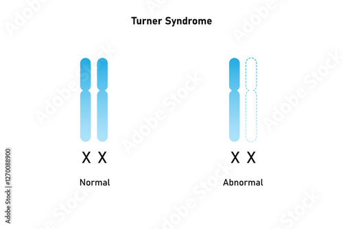 Turner Syndrome Science Design. Vector Illustration.