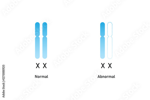 Turner Syndrome Science Design. Vector Illustration.