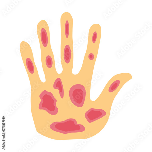 Kaposi sarcoma