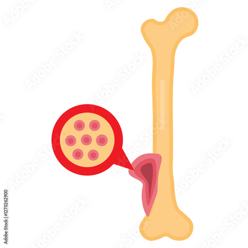 osteosarcoma