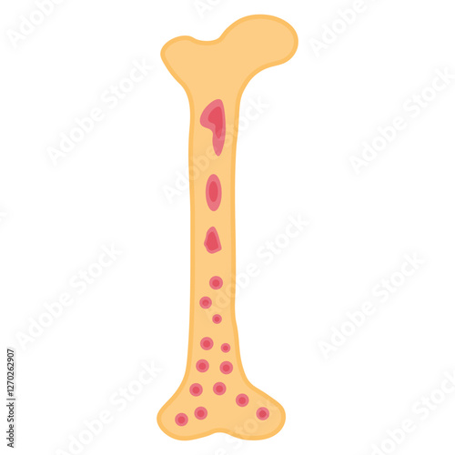 Osteomyelitis