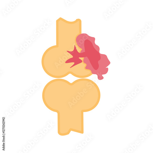 Synovial sarcoma